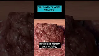 Salivary Gland Cancer: Uncovering Head and Neck Cancer Types 🎗️🩺