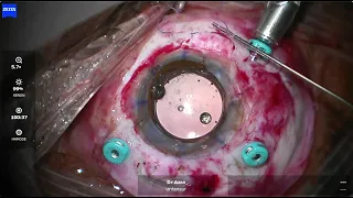 Temporary keratoprosthesis, Carlevale IOL and penetrating keratoplasty for anterior segment repair