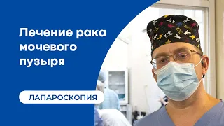 Лечение рака мочевого пузыря - лапароскопическая операция