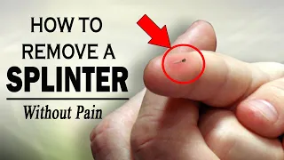 How to Remove a Splinter Without Pain || Home Remedies for Splinters Removal