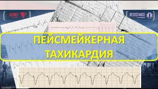 ПЕЙСМЕЙКЕРНАЯ ТАХИКАРДИЯ: виды, особенности, патогенез, диагностика, неотложная помощь