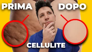 CELLULITE come ELIMINARLA: Cause, Consigli e Rimedi | Dr. Claudio Maestrini