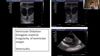 Point of Ultrasound in Newborn by Dr. Pradeep Suryavanshi
