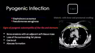 Imaging of Chest wall lesions   Prof Dr  Mamdouh Mahfouz In Arabic