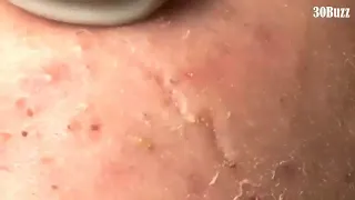 04 Huge Acne Pimples Blackheads Popping Up Satisfying with Oddly Calm Music Part One