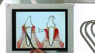 Diagnosi e cura per la piorrea o malattia parodontale