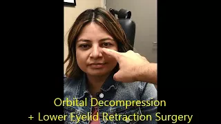 Orbital Decompression, Eyelid retraction Surgery for Graves Eye Disease