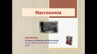 Macrosomia