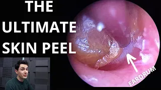 The Ultimate Skin Peel (Dead Skin Lifted From Trapped Eardrum)