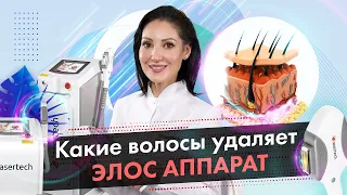 Какие волосы удаляет Элос аппарат? Элос эпиляция [LASERTECH] (18+)