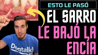 El SARRO DENTAL le bajó las ENCÍAS - Así se TRATA esta RECESIÓN