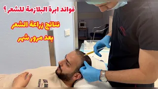 زراعة الشعر بعد شهر