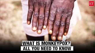 What is Monkeypox? Symptoms, transmission and vaccination process explained