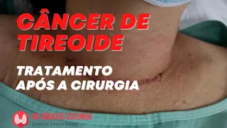 Câncer de tireoide, como é o tratamento após a cirurgia? Iodoterapia? Terapia supressiva?