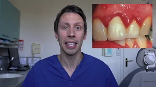 A patient's guide to gum disease & interdental cleaning
