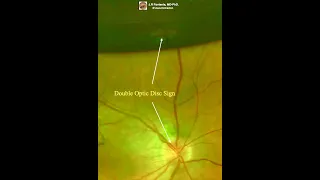 Double Optic Disc Sign.