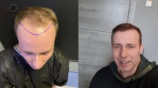 Пересадка волос до и после / видео отзыв и результат пересадки волос Алексея