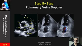 Step By Step: Pulmonary Veins Doppler
