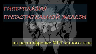 ГИПЕРПЛАЗИЯ ПРЕДСТАТЕЛЬНОЙ ЖЕЛЕЗЫ у мужчины 63 лет на расшифровке МРТ малого таза