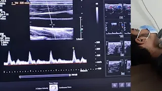 Doppler Tips - How to adjust Doppler angle for accurate velocity measurement