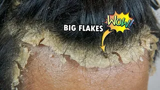 Remove Big Dandruff Flakes On Front Side ASMR #644