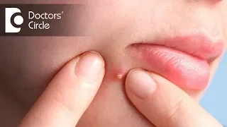 How to manage acne & pimples not responding to medicines? - Dr. Aruna Prasad