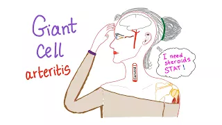 Giant cell arteritis (Temporal arteritis)