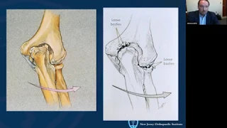 Athlete’s Elbow – Elbow Injuries in Baseball Players: How Do We Prevent and Fix Them