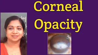 Corneal opacity// Causes // STUMPED // Grading// Nebular/Macular/Leucomatous/ Symptoms/ Management