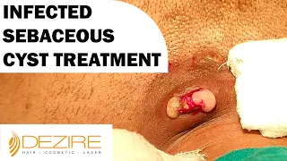 Infected Sebaceous Cyst Removal Under Local Anesthesia @DezireClinic