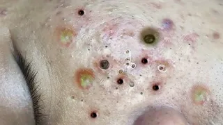 Loan Nguyen Acne spa #253