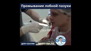 Зондирование лобной пазухи, гнойный фронтит