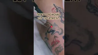 Tattoo Removal 1st treatment #tattooremoval #short