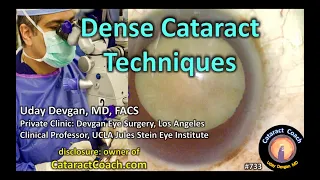 compilation video: dense cataract surgery techniques