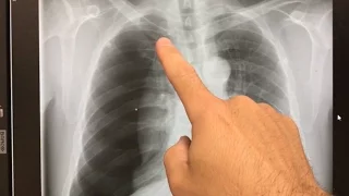 large collapsed lung  - Xray interpretation