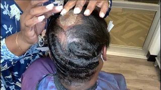 Covering a scarred Alopecia bald spot | Hair extensions for Alopecia
