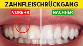 Wie du Zahnfleischrückgang natürlich behandelst