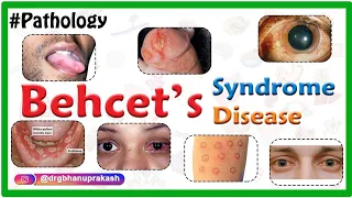 Behçet’s Syndrome/Behcet Disease : Causes, Pathology, Clinical presentation Diagnosis and Treatment