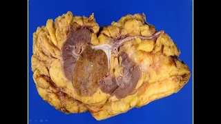 Renal cell oncocytoma