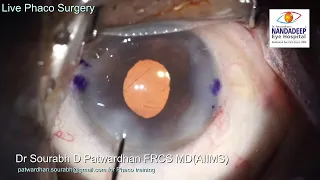 Small pupil hard cataract toric IOL 93 year old patient Live streamed