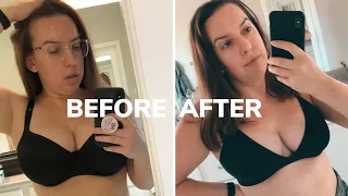 BREAST REDUCTION SURGERY 5 MONTH UPDATE: SCAR TREATMENT, SPORTS BRAS, PSORIASIS