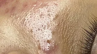 Loan Nguyen Acne Treatment (#105)