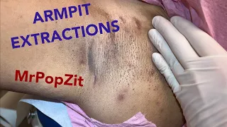 Armpit extractions. Clearing blackheads and ingrown hairs. Multiple pockets of keratin expressed.