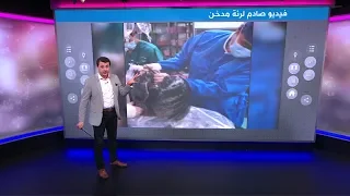 جراح صيني ينشر فيديو صادم لرئة مدخن لـ30 عاما