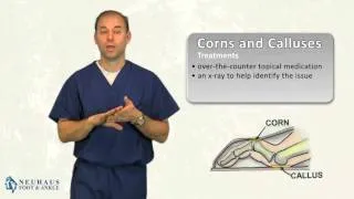 What is the Difference Between a Corn and a Callus on the Foot