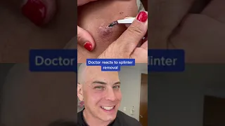 Derm reacts to MASSIVE splinter! #tree #splinter #dermreacts #doctor