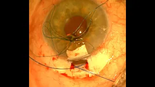 deep sclerectomy+ canaloplasty