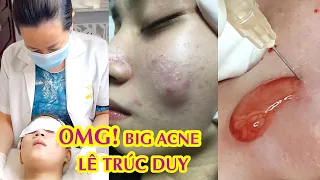 Giant Acne| Điều trị mụn, thâm hiệu quả số 1 Hiền Vân Spa | Lê Duy Trúc | 530