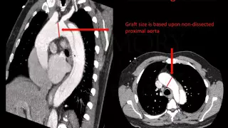 Emory Cardiology Grand Rounds 12-15-2014