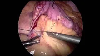 SS07 Best of Video: V023. LAPAROSCOPIC REVISION OF LONG-LIMB LOOP GASTRIC BYPASS